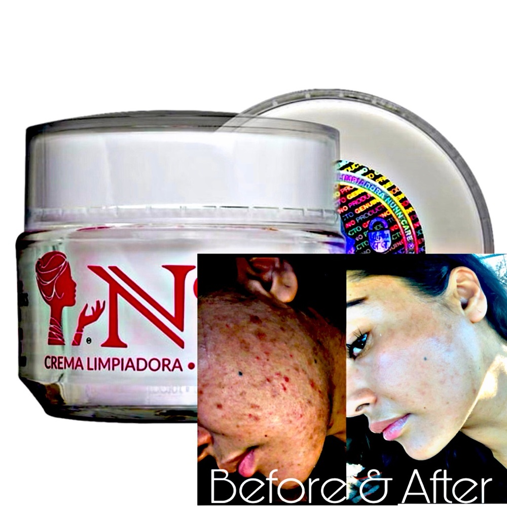 NUNN CARE CREMA LIMPIADORA 100% ORIGINAL ELIMINA ACNE MANCHAS PAÑO 1 OZ
